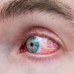 Persistent Eye Redness - Avoid Irritants and Seek Evaluation