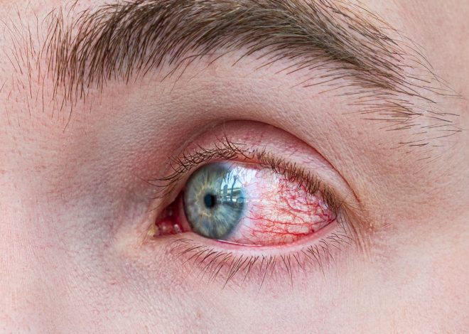 Persistent Eye Redness – Avoid Irritants and Seek Evaluation
