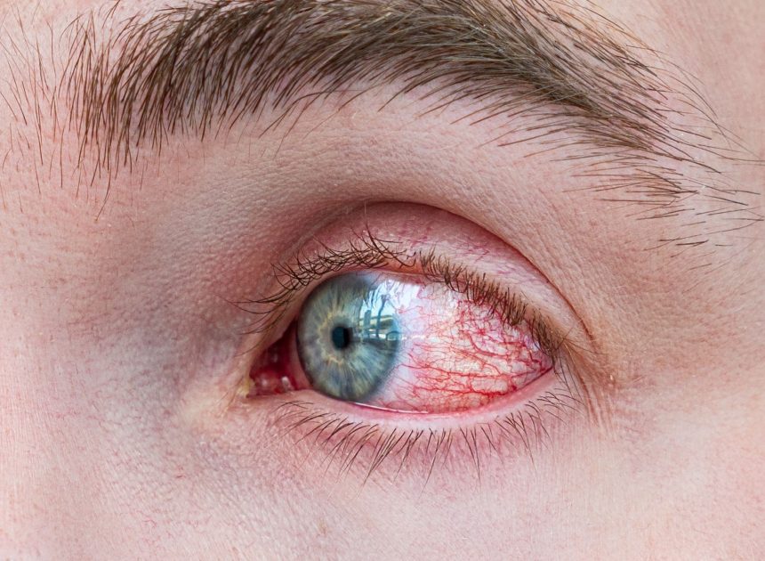 Persistent Eye Redness – Avoid Irritants and Seek Evaluation