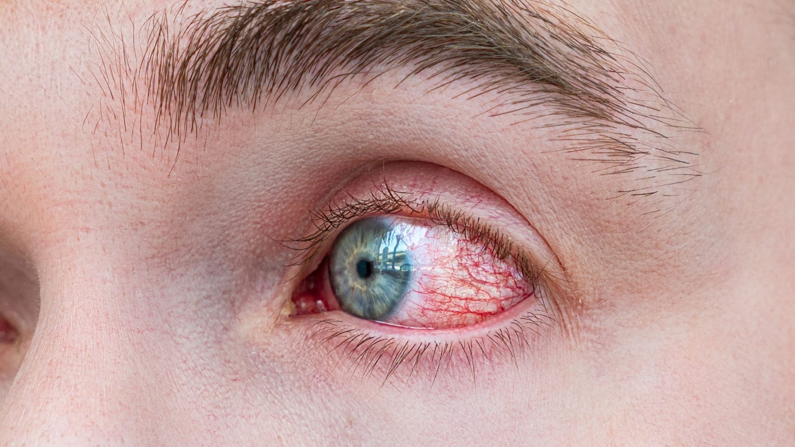 Persistent Eye Redness – Avoid Irritants and Seek Evaluation